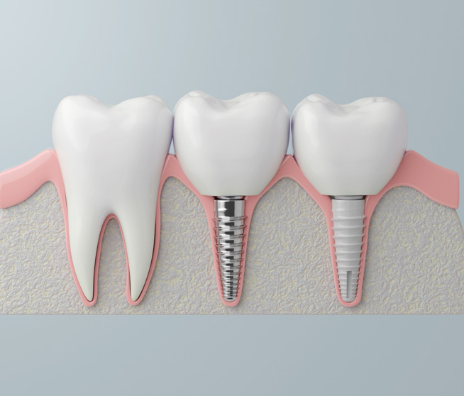 Dental Implant