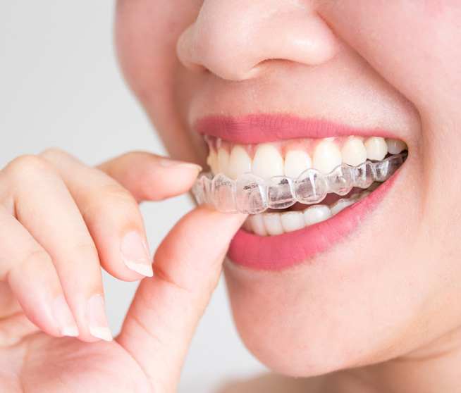 invisalign