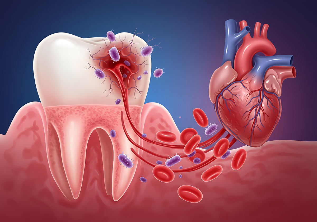 Tooth infection spreading to heart via bloodstream illustration